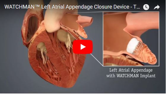 Watchman Appendage Closure Device Video Image